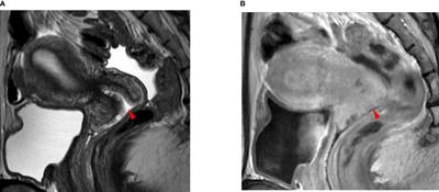 Invisible cervical cancers on MRI: Can the type of histology (SCC versus non-SCC) influence surgical planning?